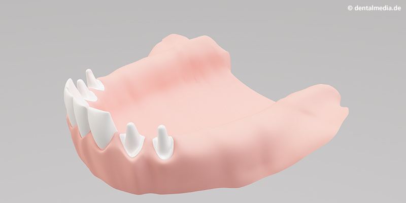 Geschiebetechnik : Ein Teil der bestehenden Zähne werden für den Kronenblock beschliffen